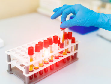 Doctors Hand Taking a Blood Sample